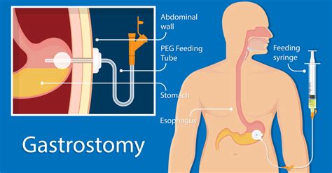 pegogram|Percutaneous Endoscopic Gastrostomy: PEG Tube Feeding,。